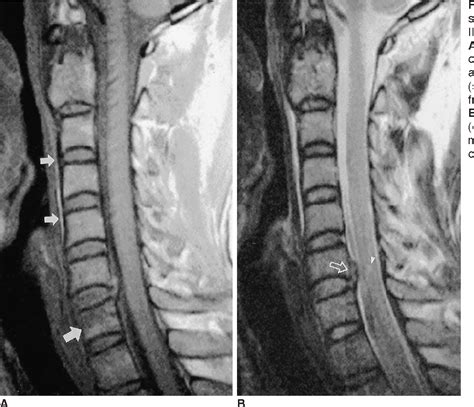 Figure 3 from Non-Contiguous Spinal Injury in Cervical Spinal Trauma ...