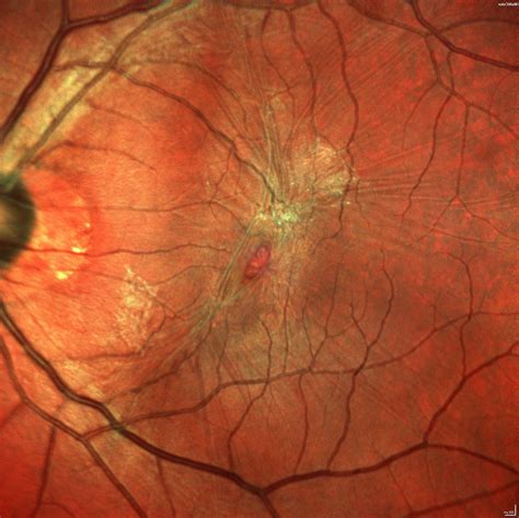 Epiretinal Membrane Peel | 16.1 | Vitreoretinal Surgery