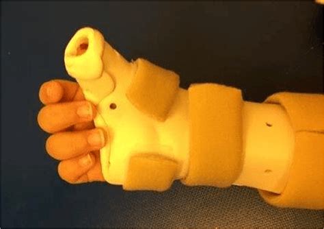 Photograph demonstrating a custom forearm-based thumb spica splint with... | Download Scientific ...