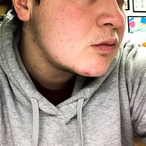 Sparse Facial Hair Growth (+ acne 😬) 5 months on T : r/ftm