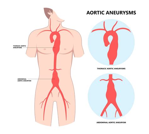 What is Aortic Root Dilatation? - Showit Blog