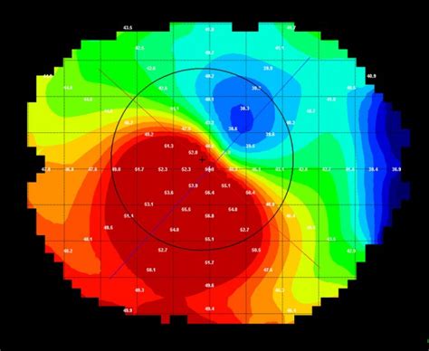 A LASIK Enhancement may NOT be the best option