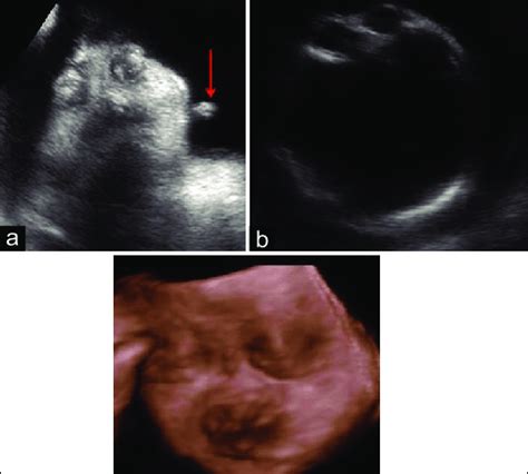 (a and b) Antenatal ultrasonography shows extreme degree of... | Download Scientific Diagram