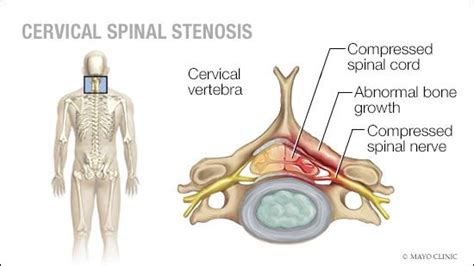 Mayo Clinic Q and A: Treating cervical spinal stenosis - Mayo Clinic ...