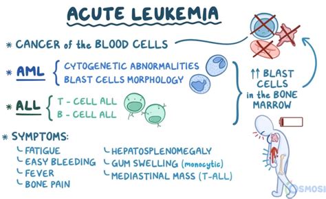 Acute and Chronic Lymphocytic Leukemia | Hematology Blueprint - Smarty PANCE