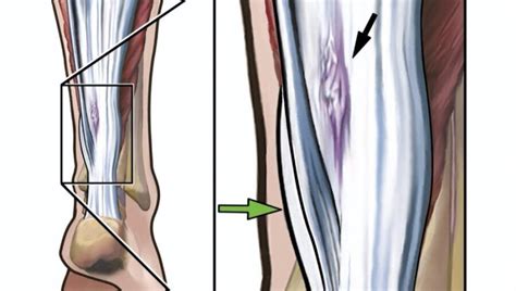 Plantaris Tendon and Achilles Tendonitis - Sport Doctor London