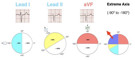 ECG Axis Interpretation • LITFL • ECG Library Basics