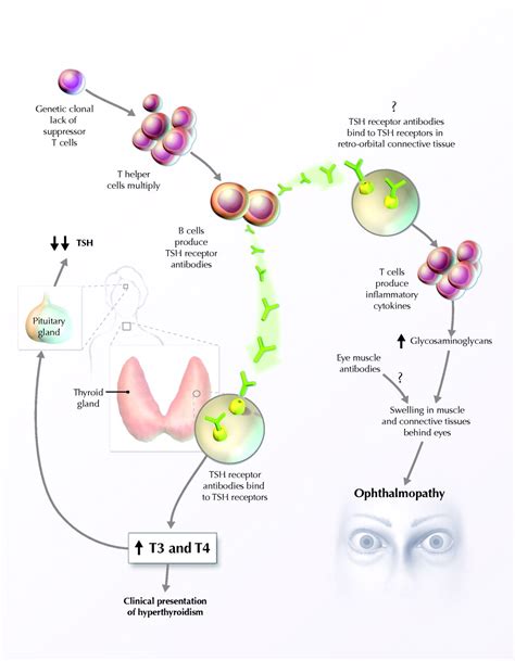 Graves Disease