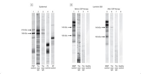 Immunoblot analyses of circulating autoantibodies in the patient's ...