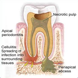 Periapical Abscess | Smiles for Life Oral Health