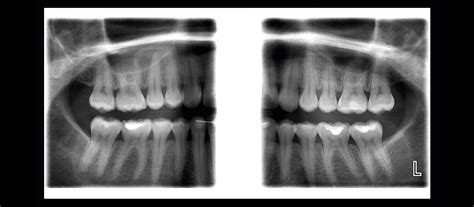 dental panoramic anatomy