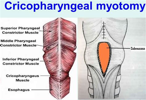 Cricopharyngeal myotomy indications, procedure, complications, recovery & prognosis