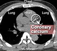 Cardiac Calcium Scoring (Heart Scan) | University of Maryland Medical Center