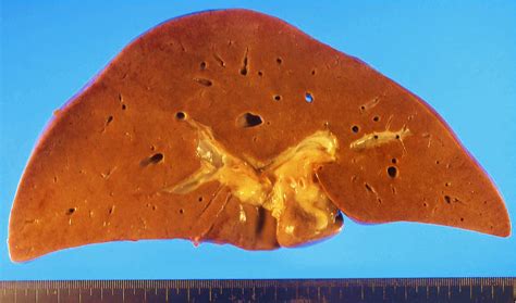 Pathology Outlines - Nonalcoholic fatty liver disease