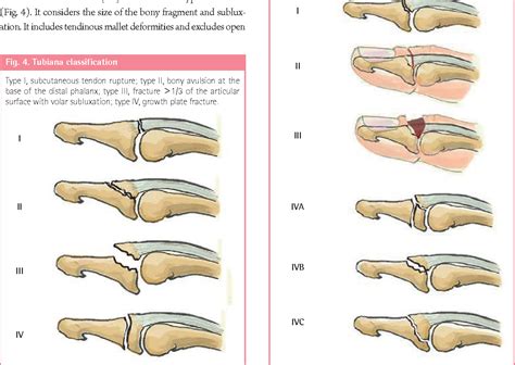 Mallet finger | Semantic Scholar