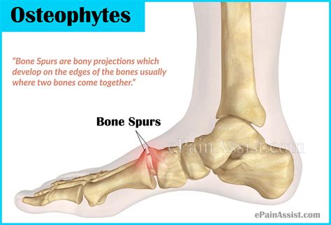 Bone Spurs or Osteophytes: Treatment, Causes, Symptoms