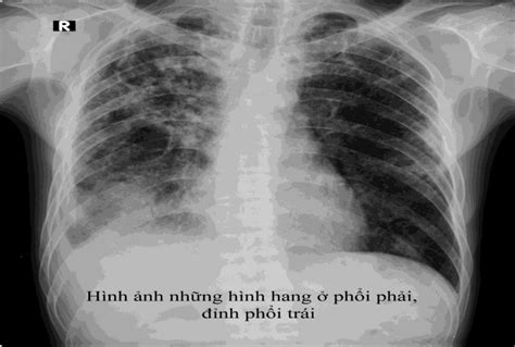 X quang trong chẩn đoán lao phổi