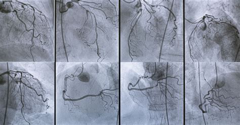 Coronary Angiography: Procedure, Side-Effects & FAQs