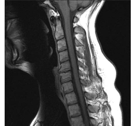 File:Cervical Spine MRI showing degenerative changes.jpg