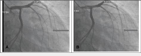 Left coronary angiogram showing severe myocardial bridging in the ...