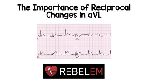 Reciprocal changes ekg - eastsadeba