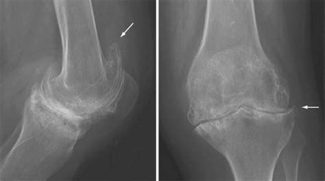 Rheumatoid Arthritis X Ray Knee