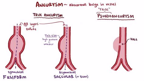 Aneurysm Overview Video