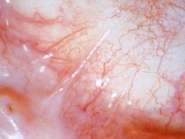 Ocular Cicatricial Pemphigoid (OCP) Clinical Presentation: History ...