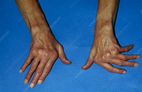 Rheumatoid arthritis of hand - Stock Image - M110/0280 - Science Photo Library