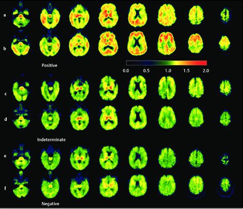 6 Amyloid image with [ 11 C] Pittsburgh Compound B PET scan. (a,b ...