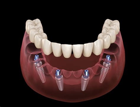 All-on-4 Fixed Implant Prosthesis - Lakeside Dental Designs