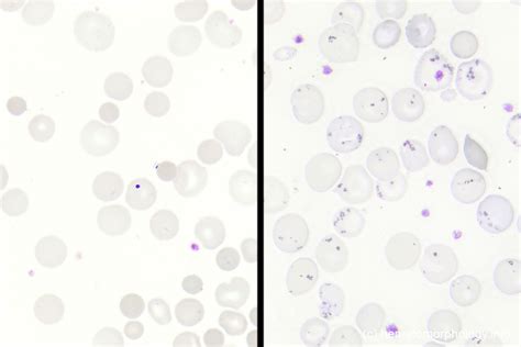 Howell Jolly bodies - Hematomorphology, a databank / imagebank for ...