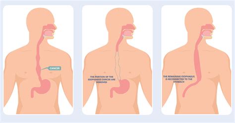 Esophagectomy: Purpose, Preparation, Procedure, Aftercare, Recovery & Risks