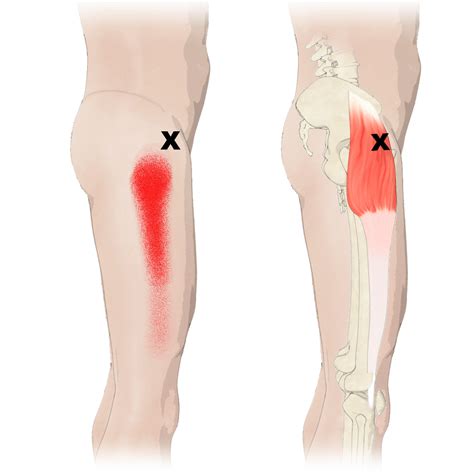 Tensor Fasciae Latae Pain