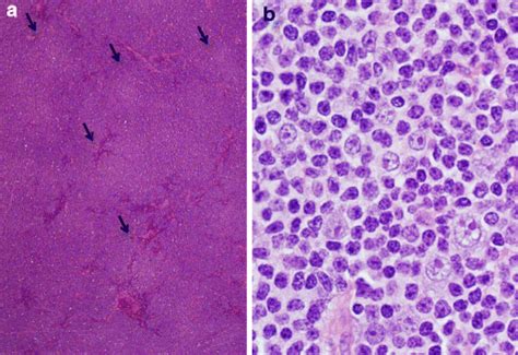 Concurrent CD5-negative small lymphocytic lymphoma (SLL) and CD5 ...