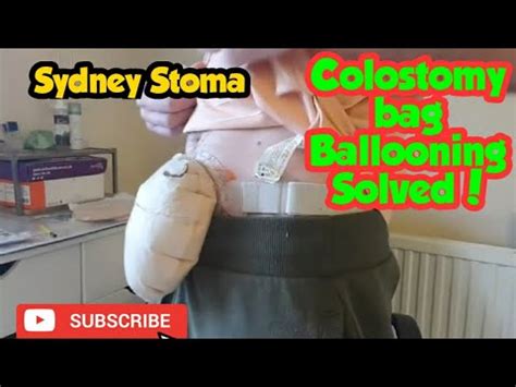 Stoma Book: Ileostomy