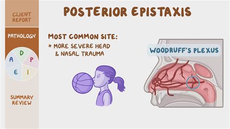 Epistaxis: What Is It, Types, Causes, Prevention,, 47% OFF