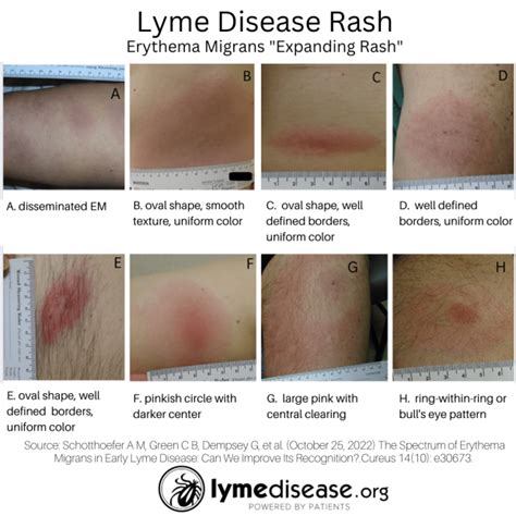 A Lyme rash doesn't always look like a bull's-eye target | LymeDisease.org