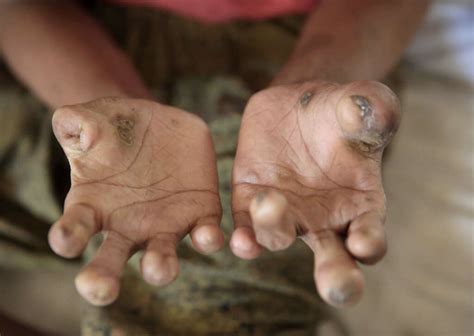 Leprosy: What Is Leprosy?