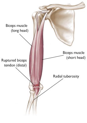 Biceps Tendon Tear at the Elbow - OrthoInfo - AAOS