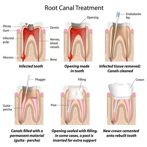 Root canal treatment (endodontic treatment) explained | News | Dentagama