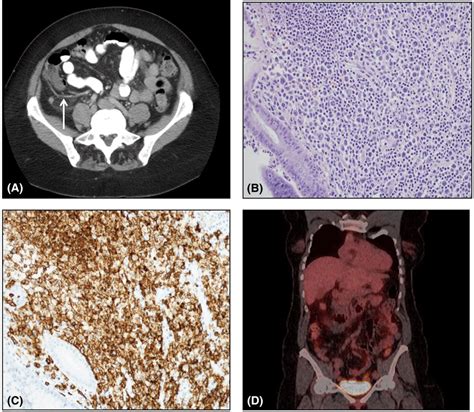 A, CT scan showing dilated appendix with nonspecific periappendiceal ...