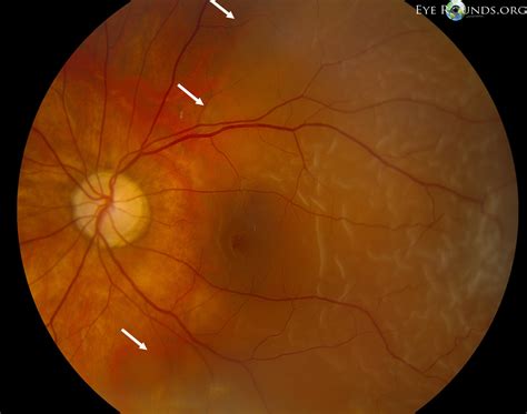 Vitreous Syneresis: An Impending Posterior Vitreous Detachment (PVD)