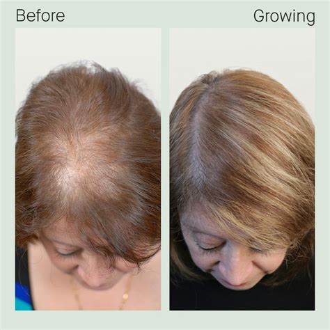 12 People Who Transformed Their Hair With Nutrafol | Nutrafol