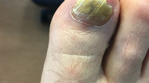 What Should I Do If My Nails Are Fungal? – Care For Feet | atelier-yuwa ...