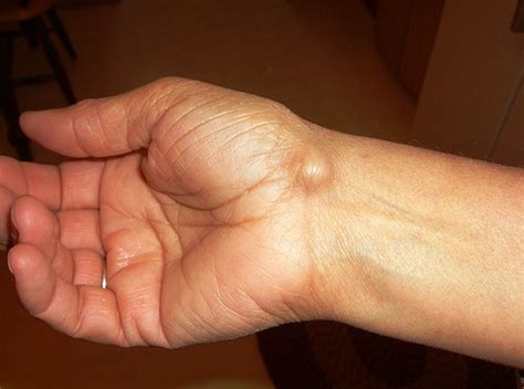 Ganglion Cyst Wrist - Pictures, Treatment, Surgery, Causes, Symptoms