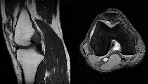 Radshare: GANGLION CYST OF KNEE