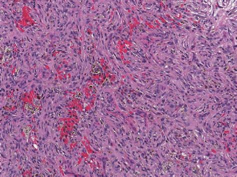 Dermatofibroma Histology