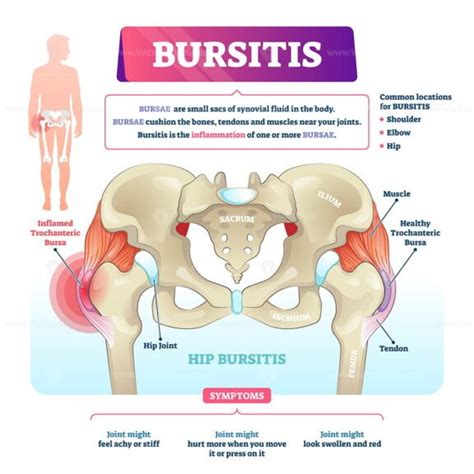 Ischial bursitis or ischiogluteal weaver's bottom condition outline diagram - VectorMine