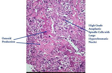 Osteosarcoma : Fibular osteosarcoma-Imaging - Sumer's Radiology Blog : «skip» metastases in ...